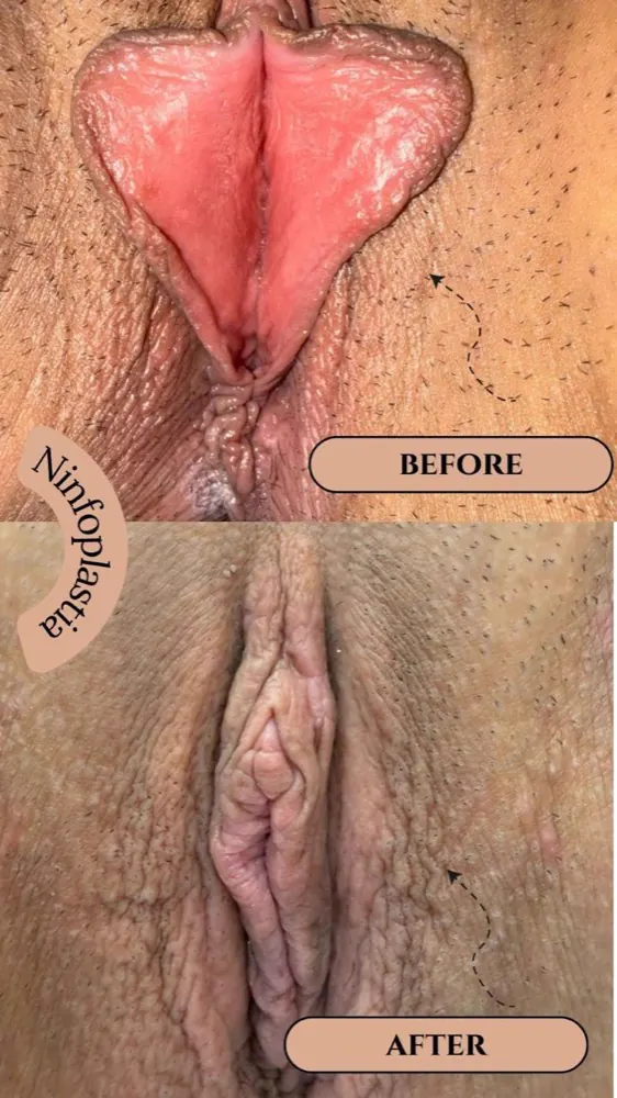 Antes e depois — ninfoplastia