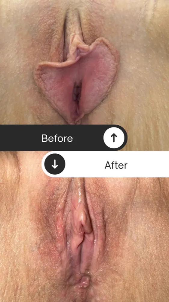 Antes e depois — ninfoplastia