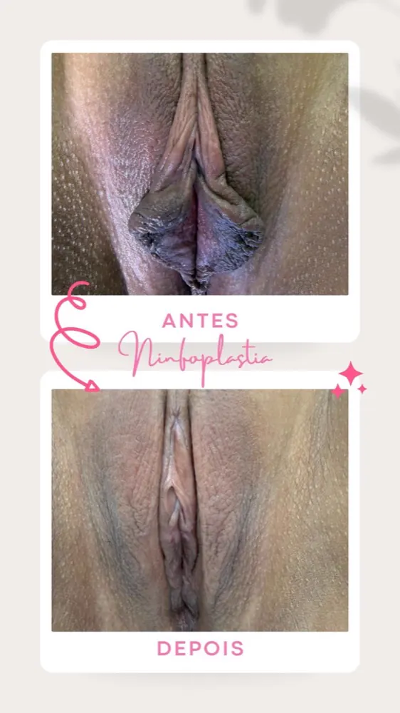 Antes e depois — ninfoplastia