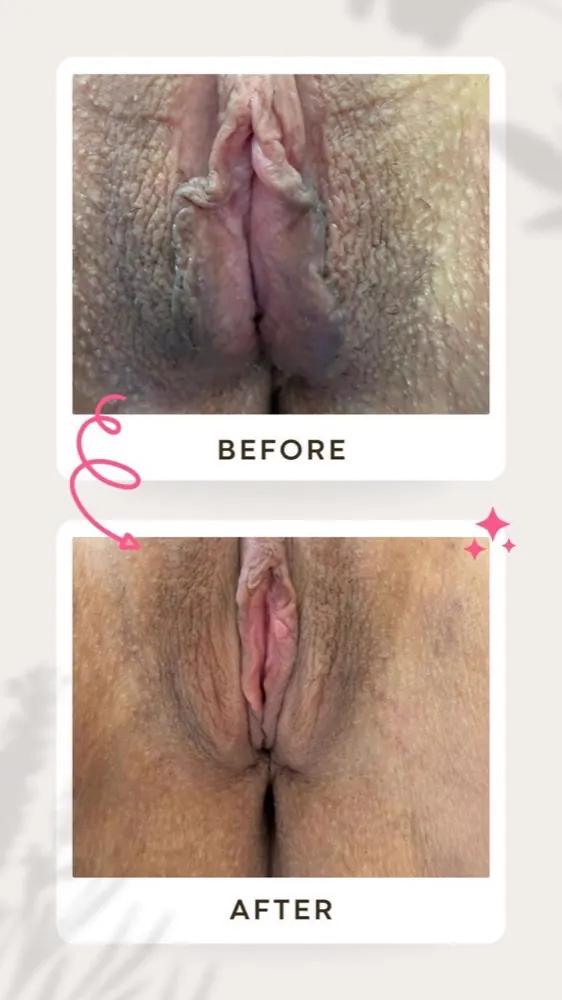 Antes e depois — ninfoplastia