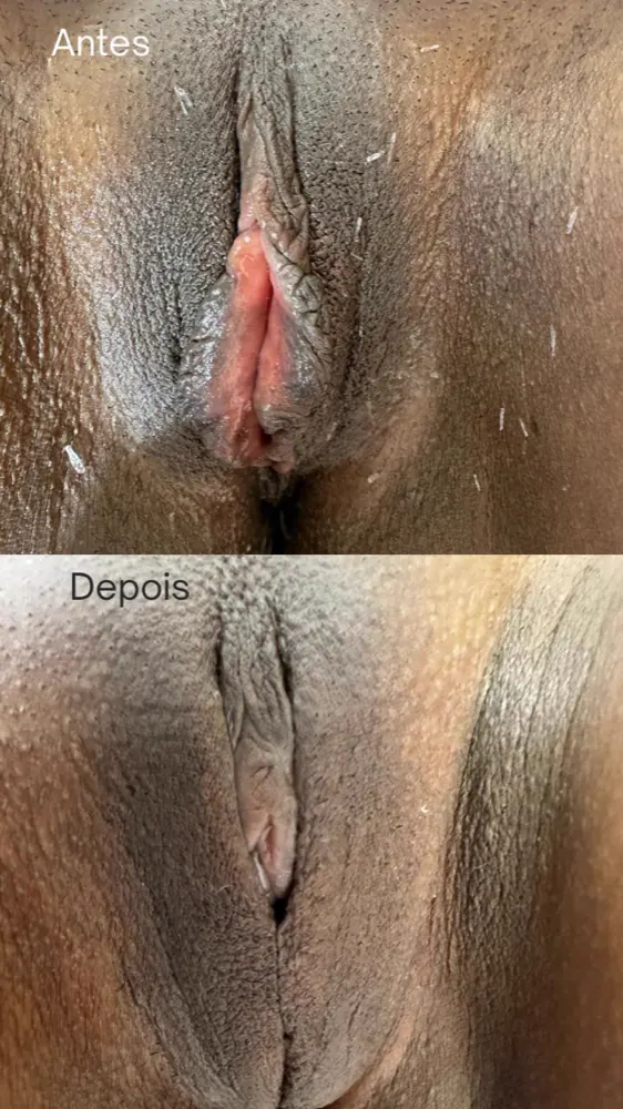 Antes e depois — ninfoplastia