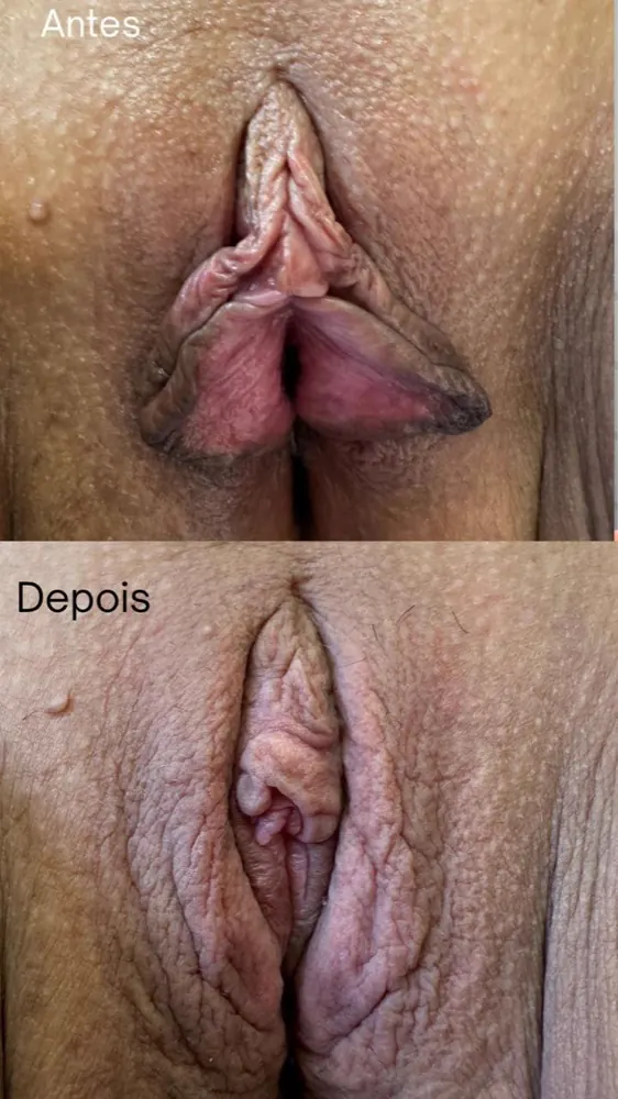 Antes e depois — ninfoplastia