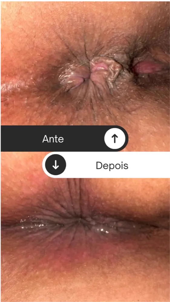 Antes e depois — plicoma anal