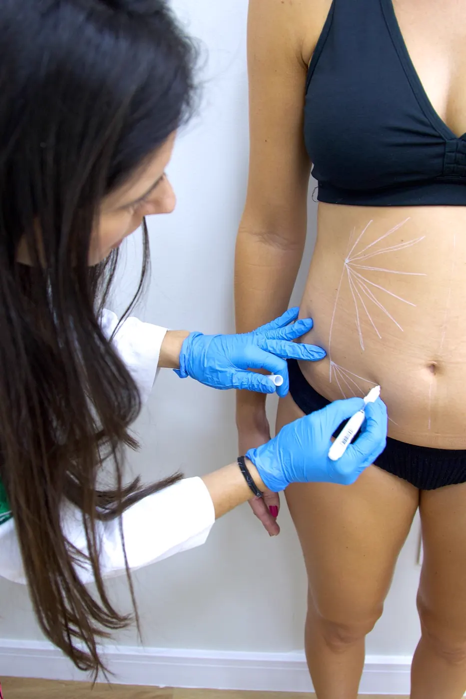 Endolaser para flacidez corporal
